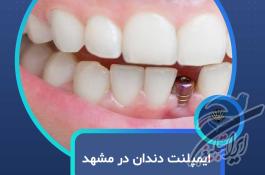 ایمپلنت دندان در مشهد  با اقساط بلندمدت و شرایط ویژه